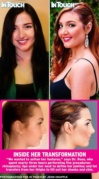 Unretouched rhinoplasty images