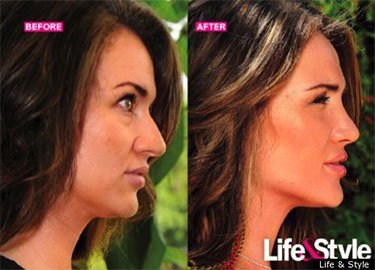 Rhinoplasty Photo Gallery