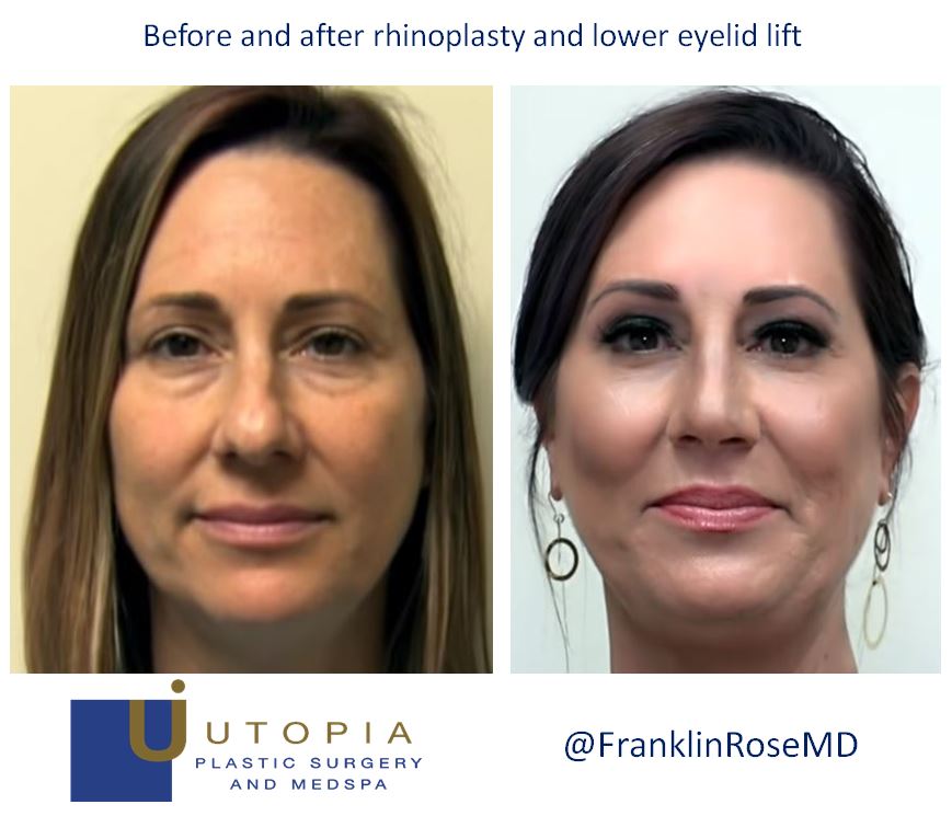 before-after-rhinoplasty-houston-plastic-rose