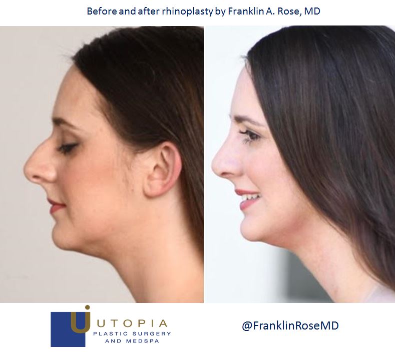 before-after-rhinoplasty-houston-plastic-franklin-rose