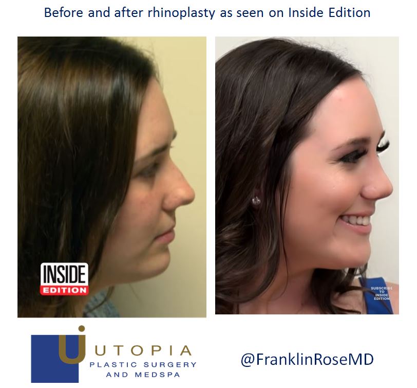 before-after-rhinoplasty-houston-plastic-rose