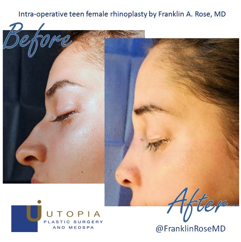 before and after teen rhinoplasty houston